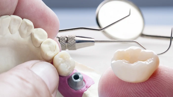 zobna implantacija