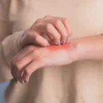 atopijski-dermatitis-njegove-faze-in-kako-ublaziti-simptome.webp.webp